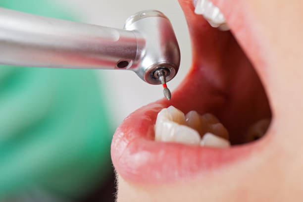 Best Emergency Dentist for Lost Fillings or Crowns in Crest, CA